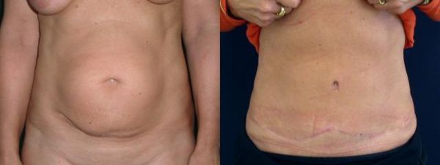 abdominoplastika4a