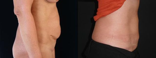 abdominoplastika4b