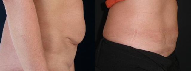 abdominoplastika4c