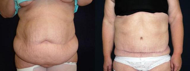 abdominoplastika5a