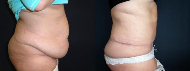 abdominoplastika5b