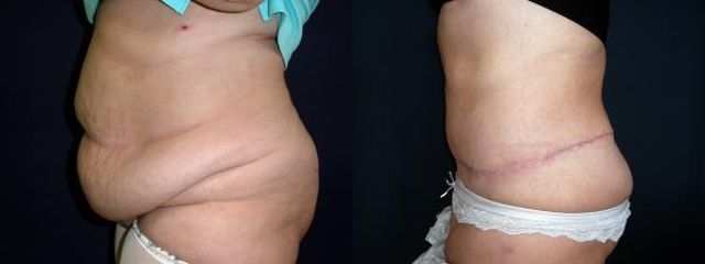 abdominoplastika5c
