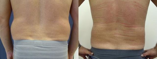 liposukce2c