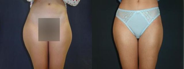 liposukce3a