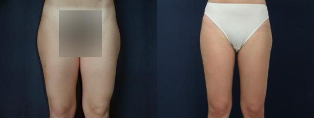 liposukce4a