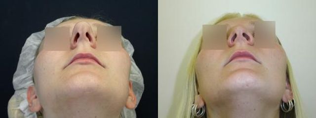 rhinoplastika 2b blur