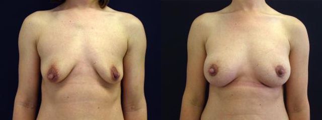 modelace s implantaty 2a