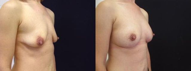 modelace s implantaty 2c