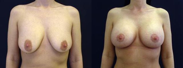 modelace s implantaty 3a
