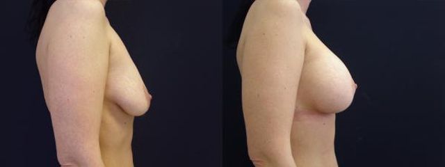 modelace s implantaty 3b