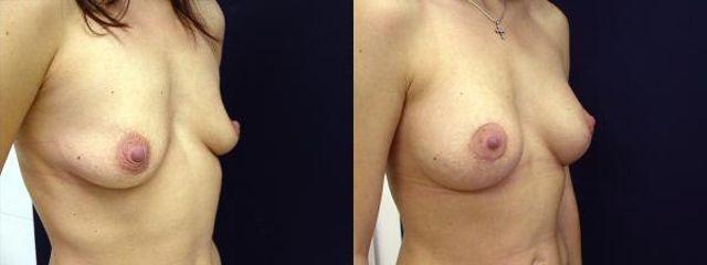 modelace s implantaty 4c