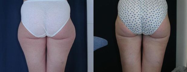 liposukce 1