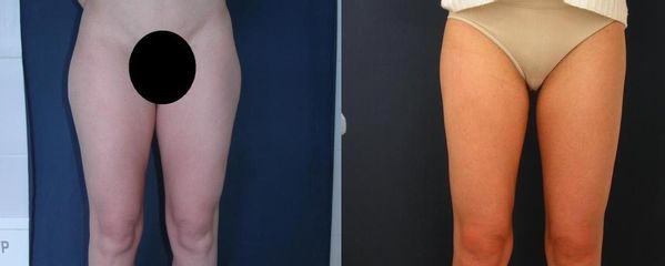 liposukce 2