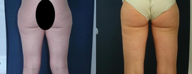liposukce 3