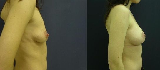 prsa 4