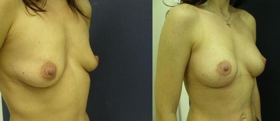 prsa 5