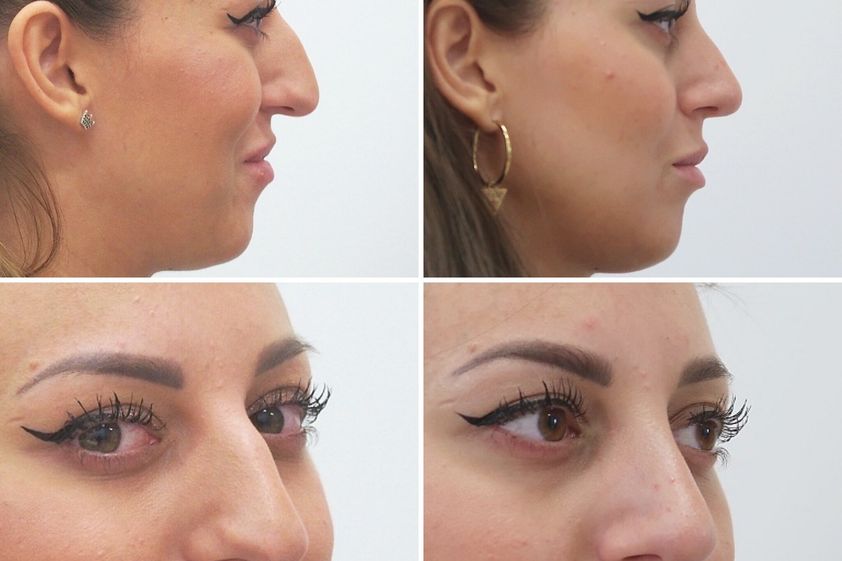 Rhinoplastika před a po - 852262