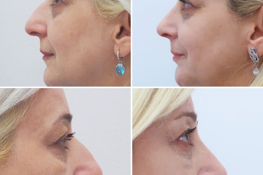 Rhinoplastika před a po - 852263
