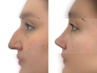 Rhinoplastika před a po - 880902