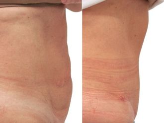 Abdominoplastika před a po - 880925