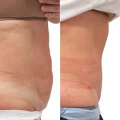 Plastická operace břicha, tzv. abdominoplastika - MUDr. Martin Kubát