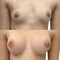 Zvětšení prsou implantáty - MUDr. Martin Kubát