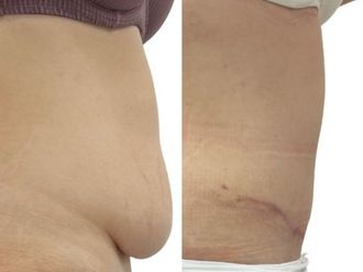 Abdominoplastika před a po - 880938