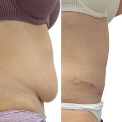 Plastická operace břicha, tzv. abdominoplastika - MUDr. Martin Kubát