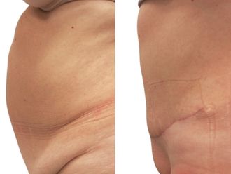 Abdominoplastika před a po - 880943