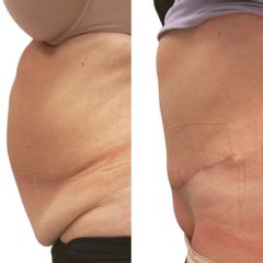 Plastická operace břicha, tzv. abdominoplastika - MUDr. Martin Kubát