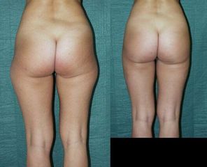 lipopred