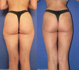 muel lipo z valy p 1