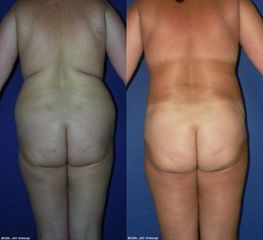 bed lipo boky p 1