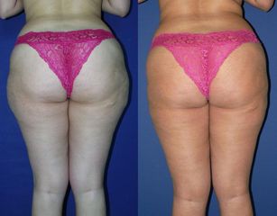 noh lipo z valy p 1