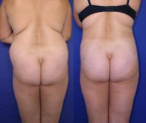 Kup lipo boky a zada p 1