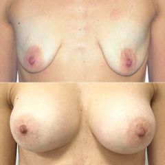 Zvětšení prsou implantáty vč. modelace - MUDr. Pavel Kobzík