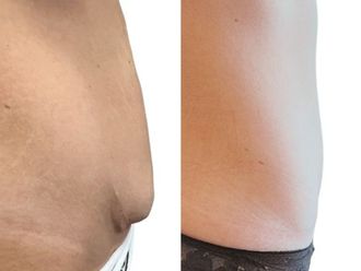 Abdominoplastika před a po - 880972