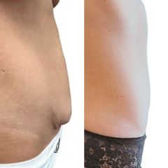 Plastická operace břicha, tzv. abdominoplastika - MUDr. Pavel Kobzík