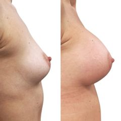 Zvětšení prsou implantáty - MUDr. Pavel Kobzík