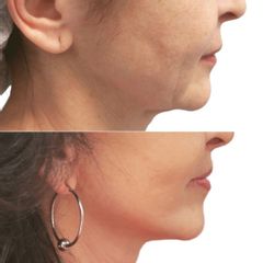 Plastická operace obličeje, tzv. Myfacelift - MUDr. Pavel Kobzík