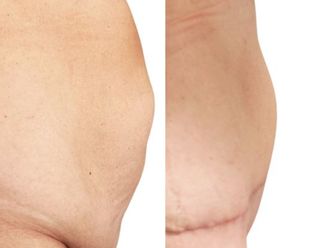 Abdominoplastika před a po - 881010