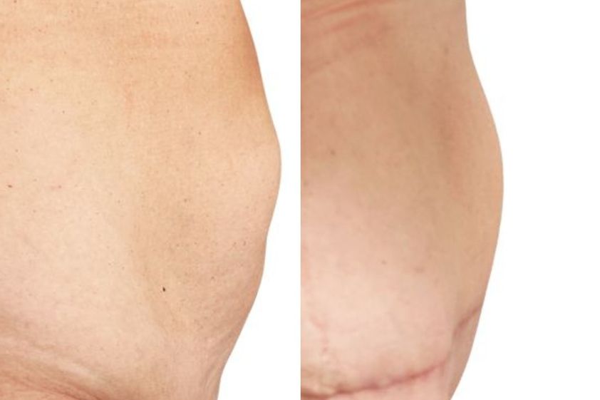 Abdominoplastika před a po - 881010