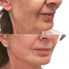 Plastická operace obličeje, tzv. Myfacelift - MUDr. Pavel Kobzík