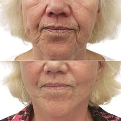 Plastická operace obličeje, Myfacelift - MUDr. Pavel Kobzík