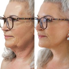 Plastická operace obličeje, Myfacelift - MUDr. Pavel Kobzík