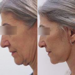 Plastická operace obličeje, Myfacelift - MUDr. Pavel Kobzík