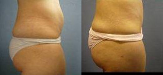 lipo1a