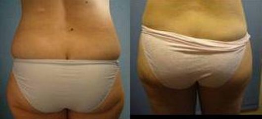 lipo2a