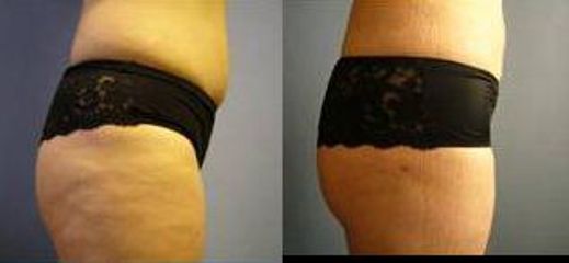 lipo3a