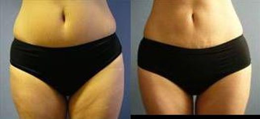 lipo4a